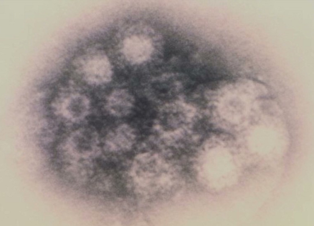 enterovirus infections